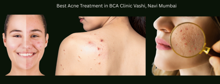 BCA Clinic Vashi: The Most Trusted Anti-Acne Treatment Centre in Navi Mumbai